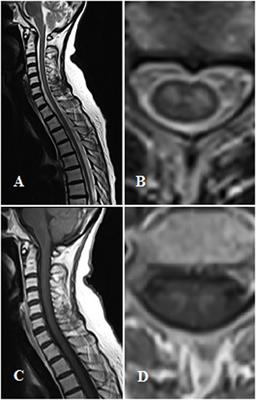 Acute Flaccid Paralysis by Enterovirus D68 Infection: First Italian Description in Adult Patient and Role of Electrophysiology